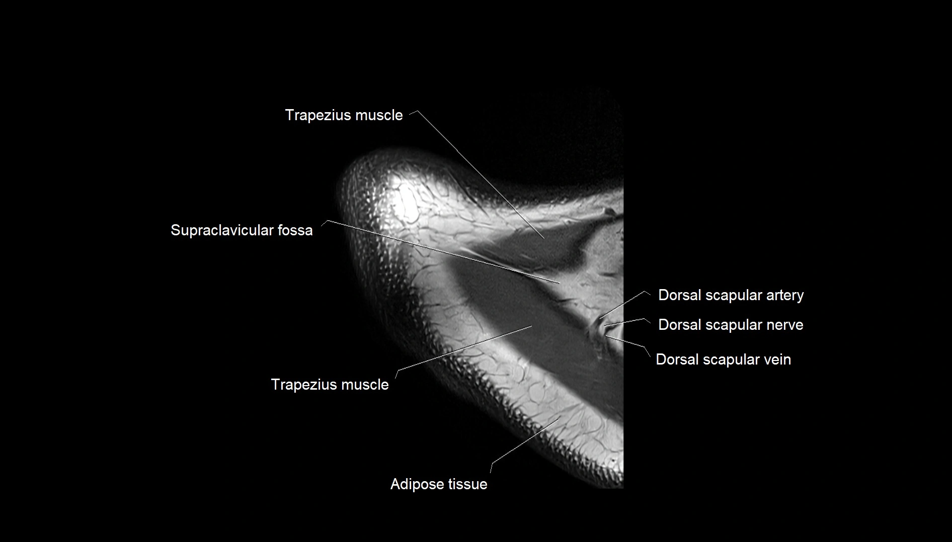 Shoulder cross sectional anatomy MRI 3T axial image 2.webp
